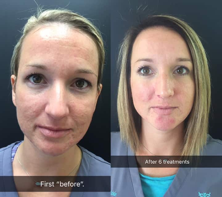 PRP Facials at origin dental