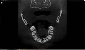 Cone Beam CT Scan