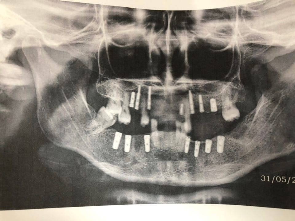 CBCT