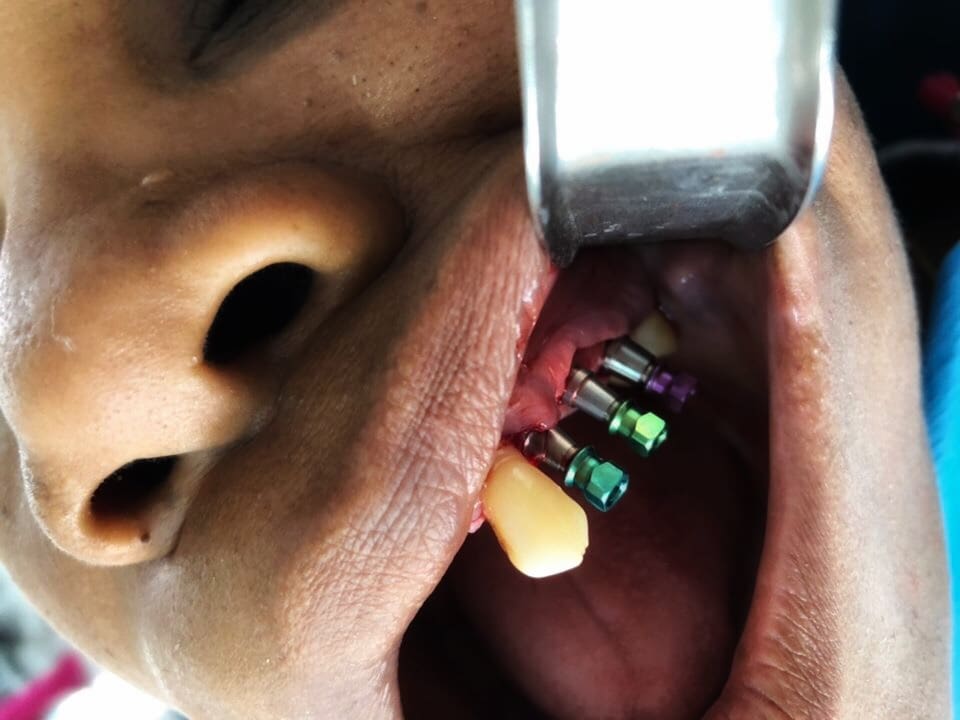 Implants 1