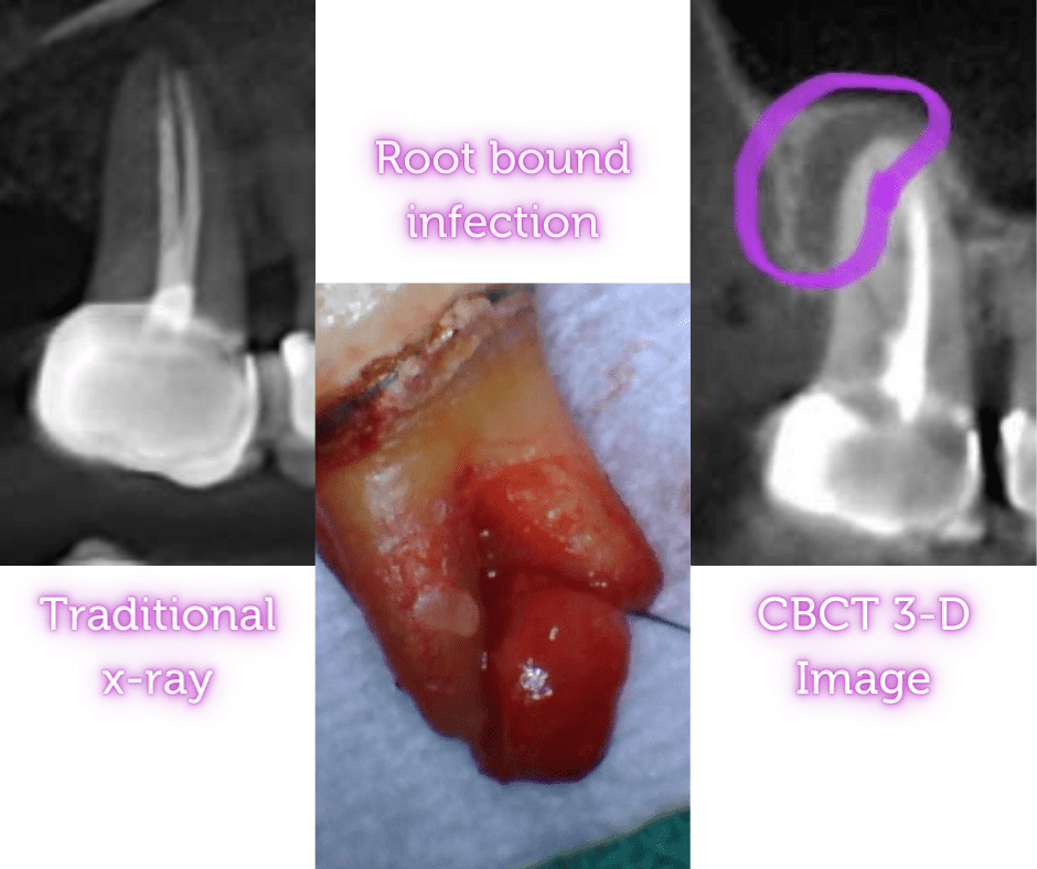 Root Canal