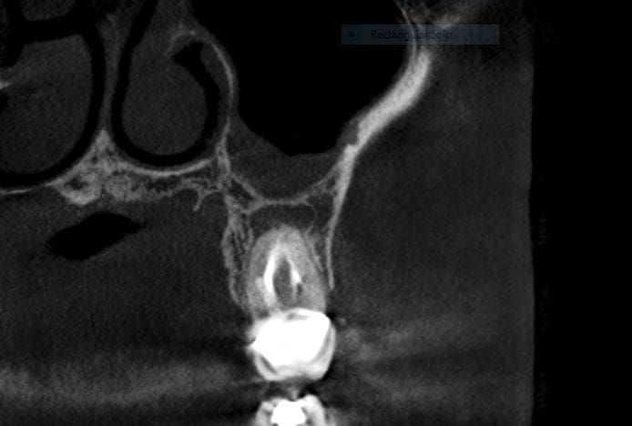 Root Canals